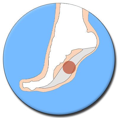 Cavus Foot Insoles - The Insole Store