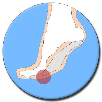Ball-of-Foot Pain - The Insole Store